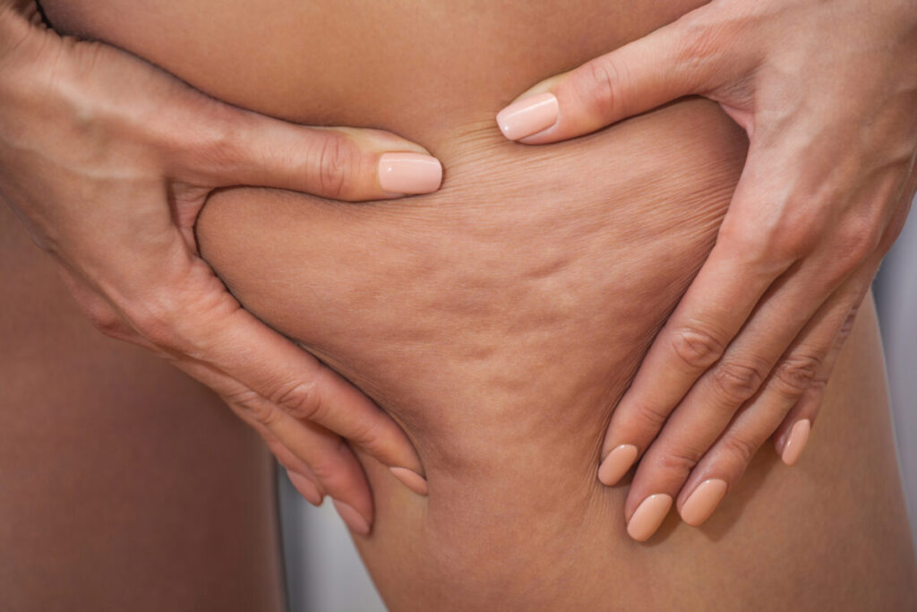 脂肪吸引後のしこりは大丈夫？拘縮・血腫・漿液腫の見分け方【六本木の術後ケアBliss】